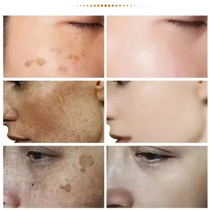 Anti Dark Spot Brightening Cream – Melasma, Freckle & Pigmentation Remover