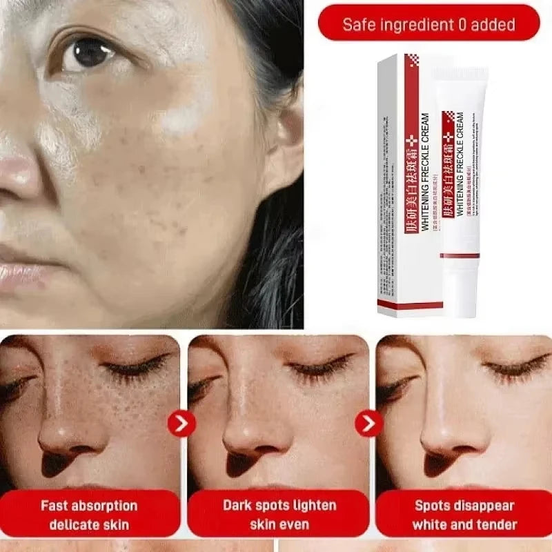 Anti Dark Spot Brightening Cream – Melasma, Freckle & Pigmentation Remover