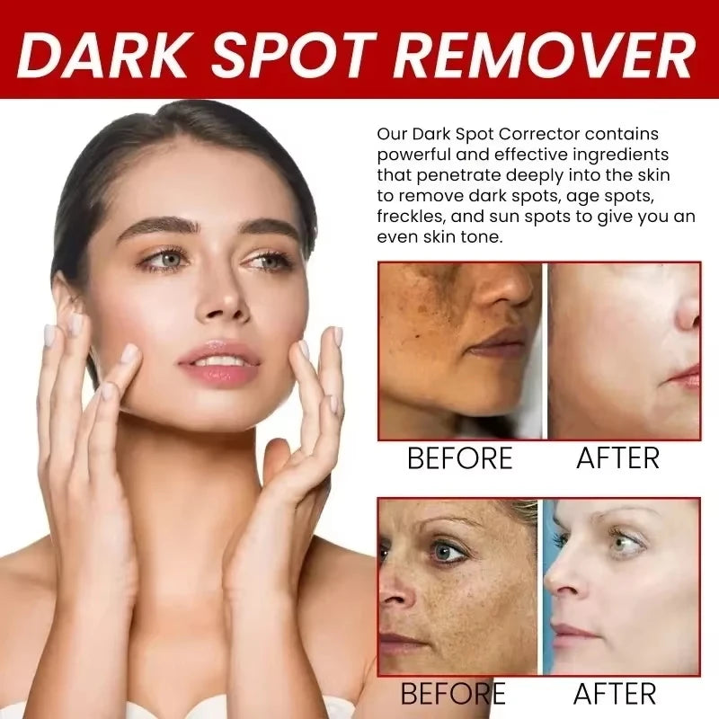 Anti Dark Spot Brightening Cream – Melasma, Freckle & Pigmentation Remover