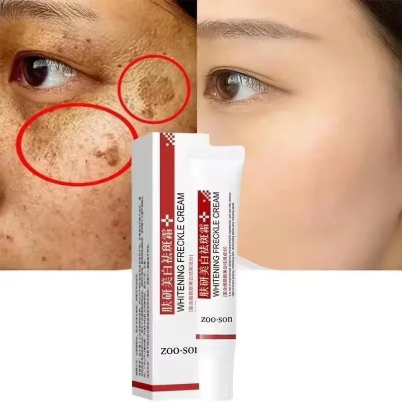 Anti Dark Spot Brightening Cream – Melasma, Freckle & Pigmentation Remover