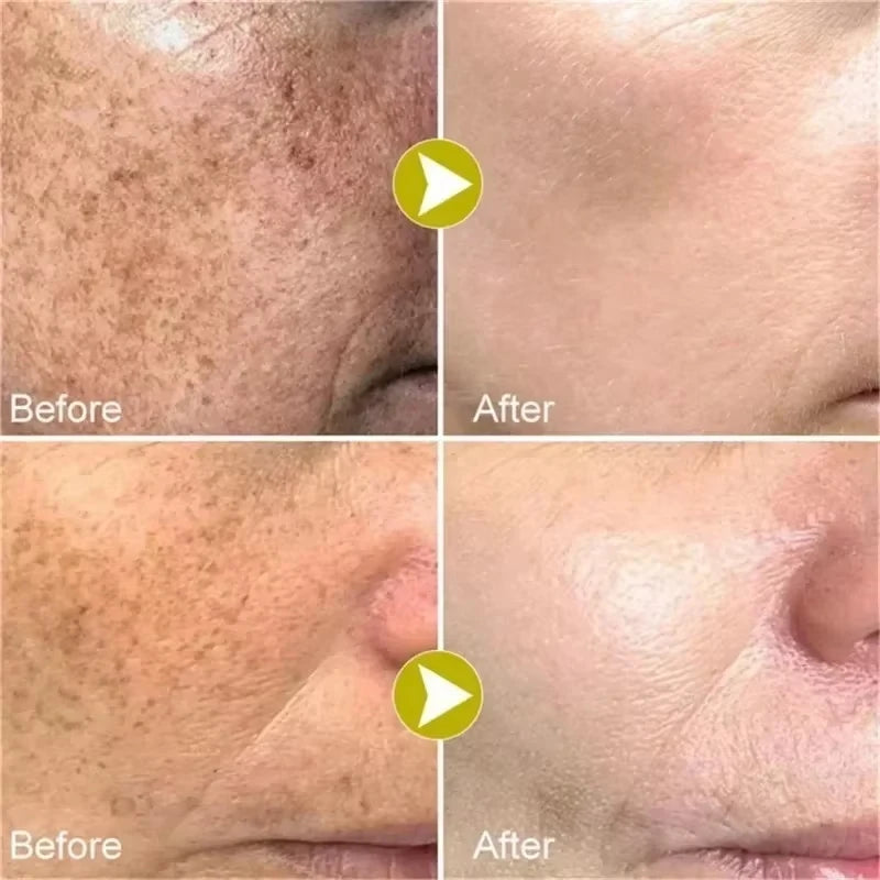 Anti Dark Spot Brightening Cream – Melasma, Freckle & Pigmentation Remover